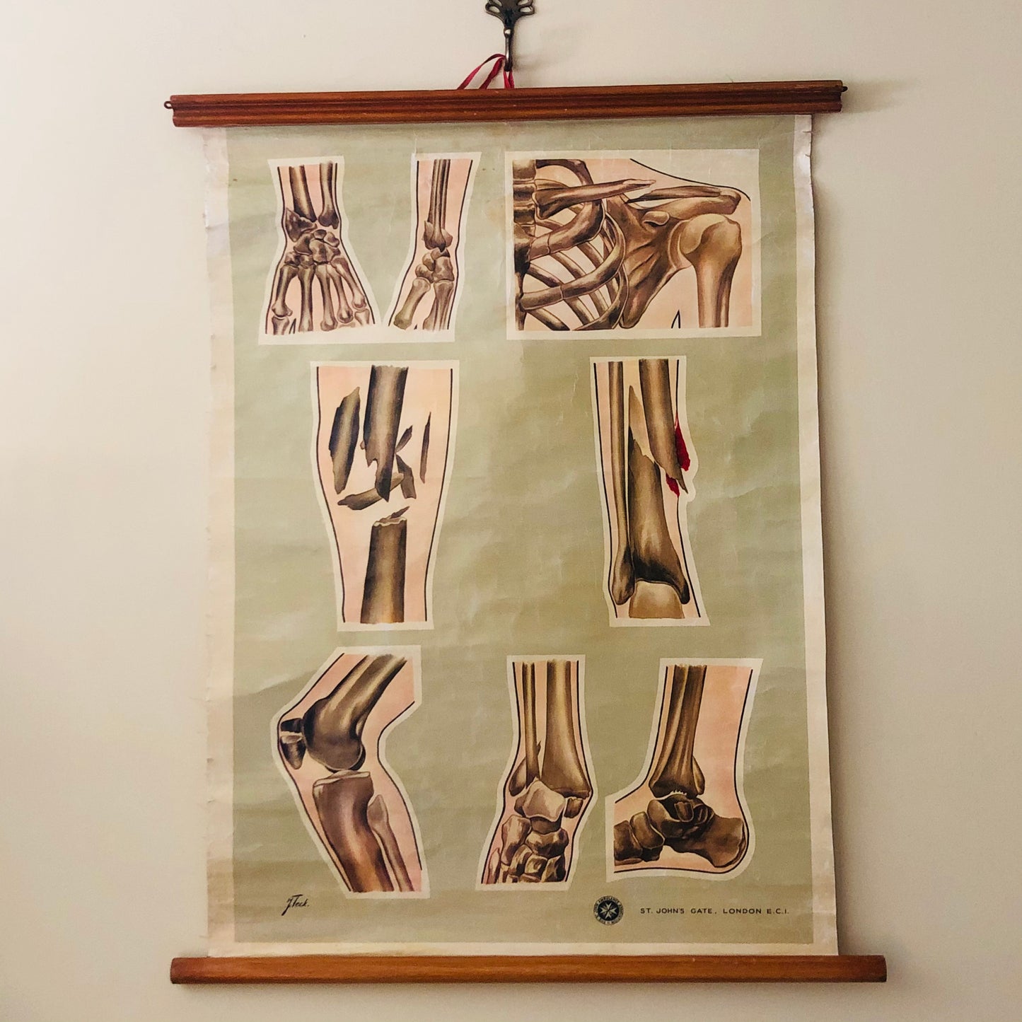 Vintage Fracture Poster St John Ambulance Anatomical By J Teck