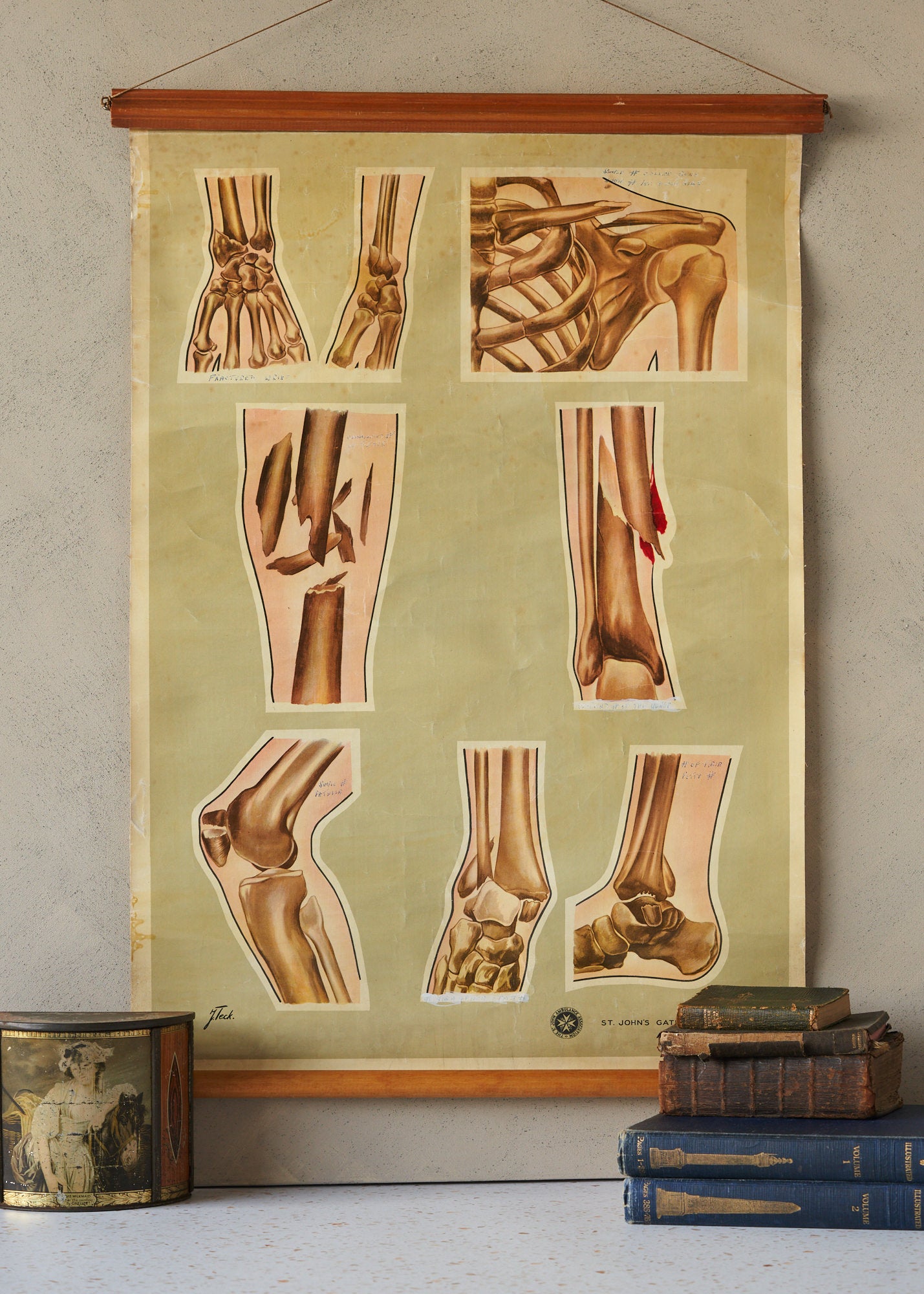 The Director Ash - Vintage Anatomy Medical Fracture Poster